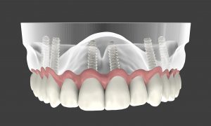 השתלת שיניים במצב חוסר קיצוני בנפח עצם